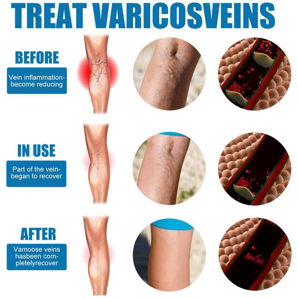 Treat Varicose Green Veins - Image 4