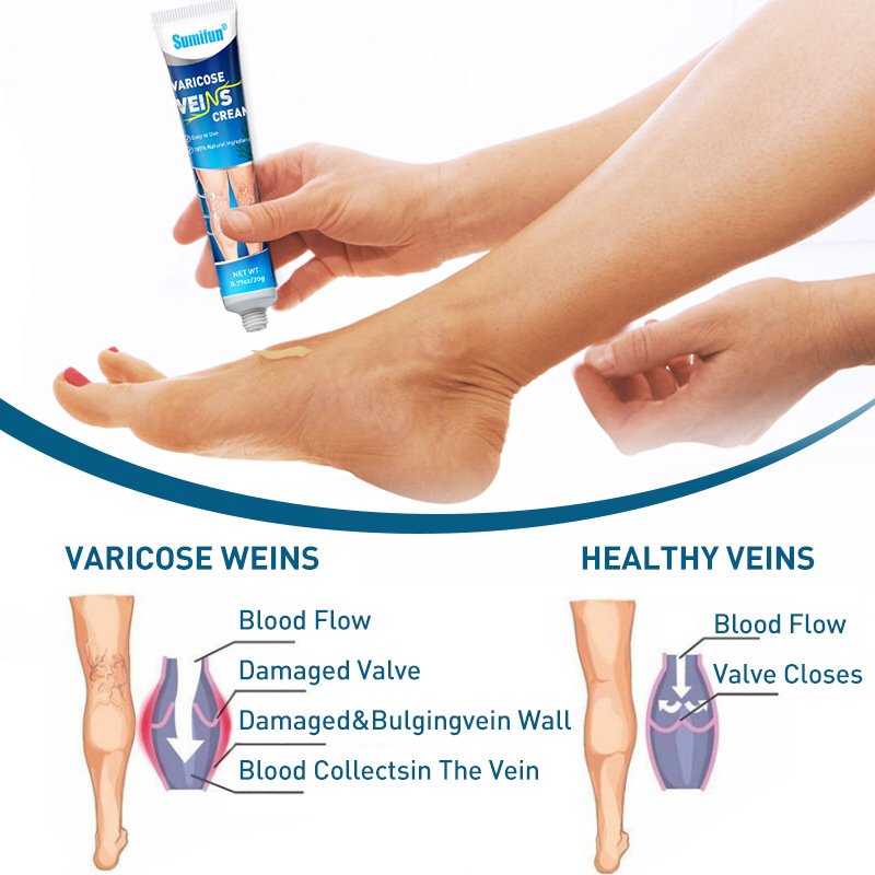 Treat Varicose Green Veins