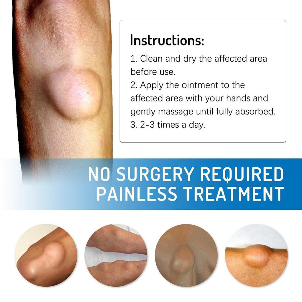 Lipoma Removal - Image 2